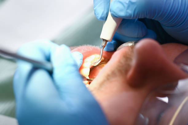 Best Emergency Wisdom Teeth Removal in Nokesville, VA